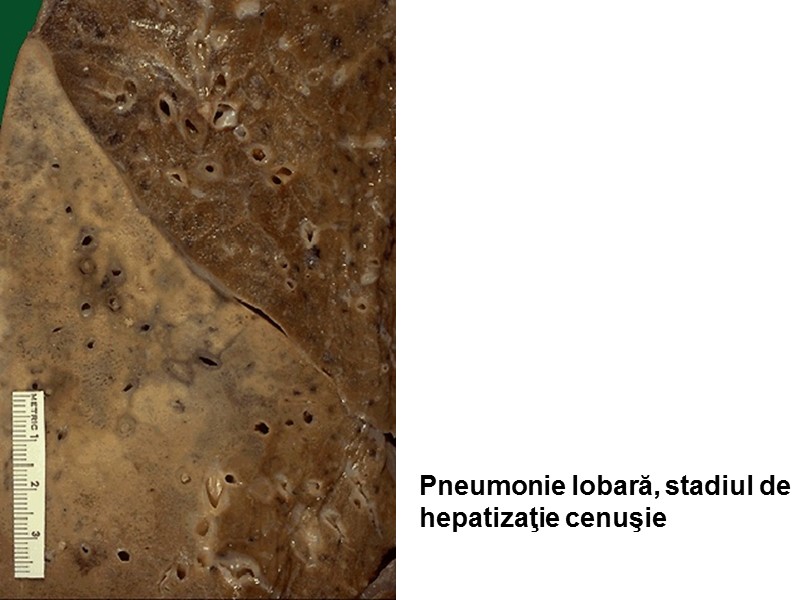 Pneumonie lobară, stadiul de  hepatizaţie cenuşie